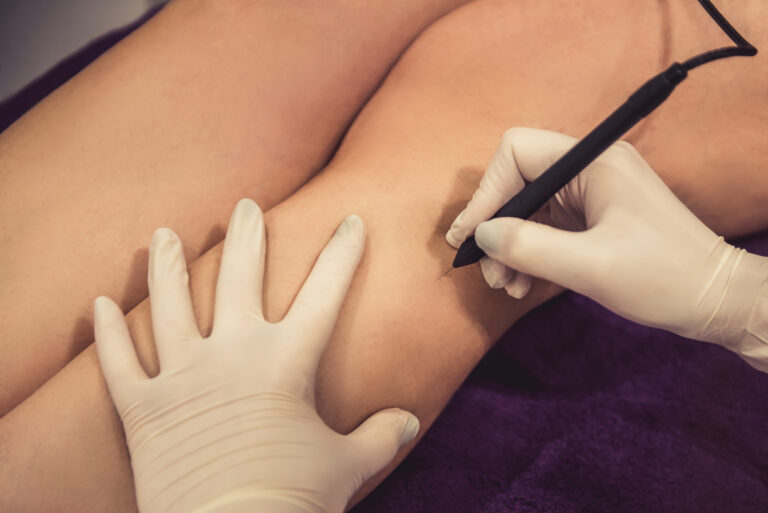 Epilation Unterschenkel
