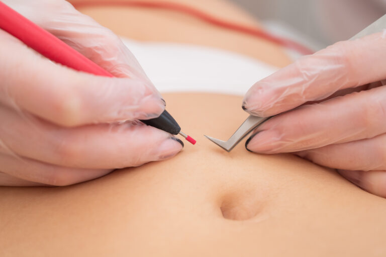 Auch am Bauch sind oft überflüssige Haare