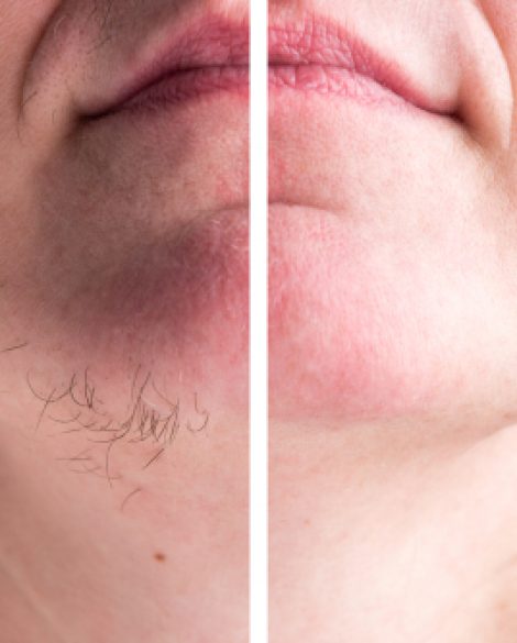 Woman,With,Hairs,On,Chin.,Hair,Removal,On,Face.